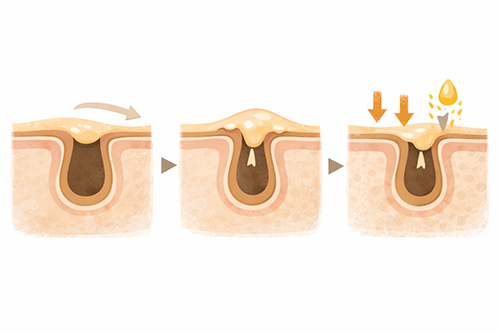 毛穴落ちが起こるのはなぜ?時間とともに目立つ理由