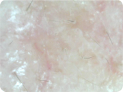 敏感肌のマイクロスコープ写真